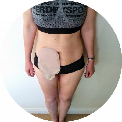 Bladder removal
