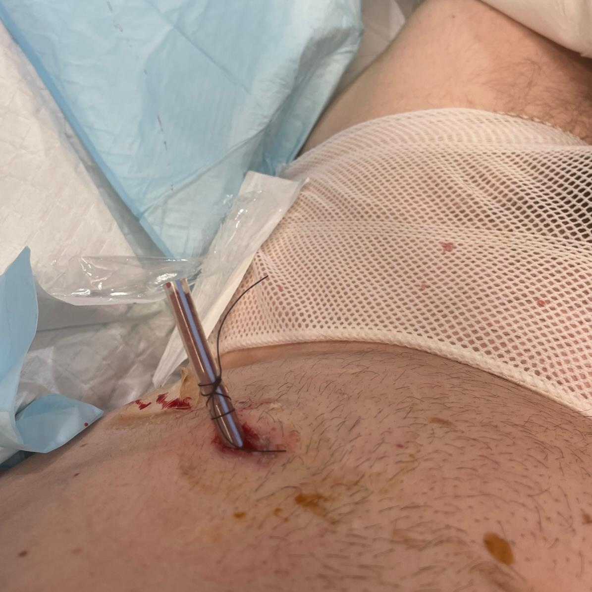 Graphic image from Adam Smith’s bladder cancer surgery and recovery