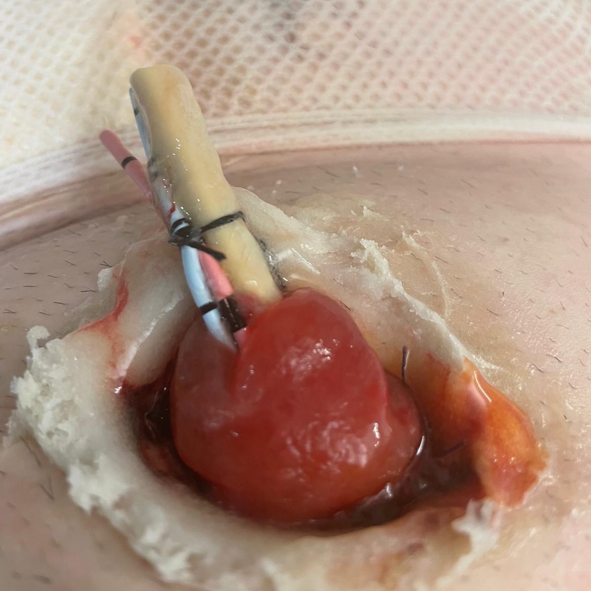 Graphic image from Adam Smith’s bladder cancer surgery and recovery