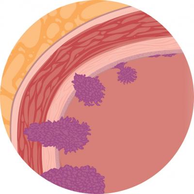 Types and stages of bladder cancer